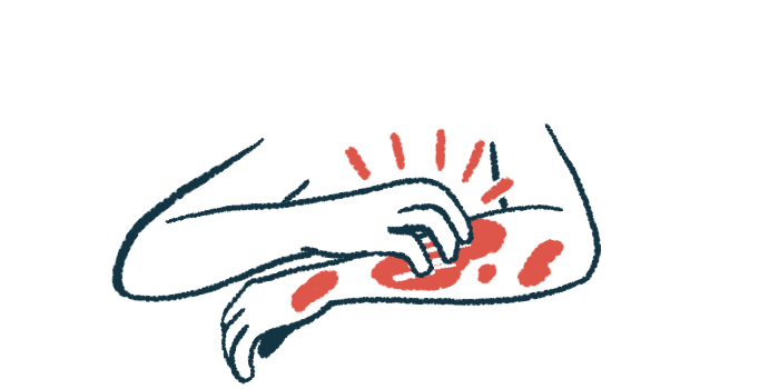 A person's hand is shown scratching the other arm, which is covered in red blotches.